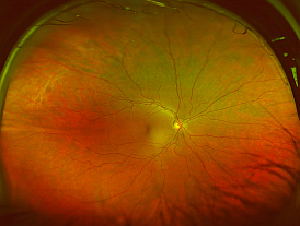 A healthy retina image from the Optomap